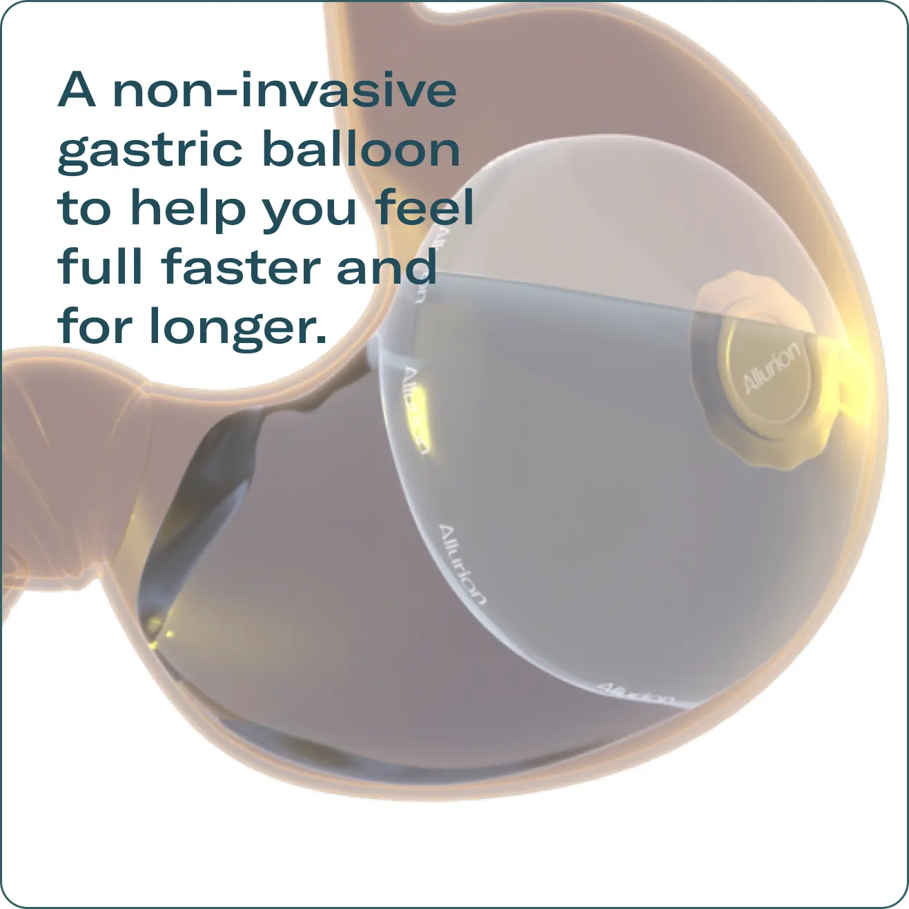 A Non-invasive gastric balloon to help you ffel full faster and for longer 